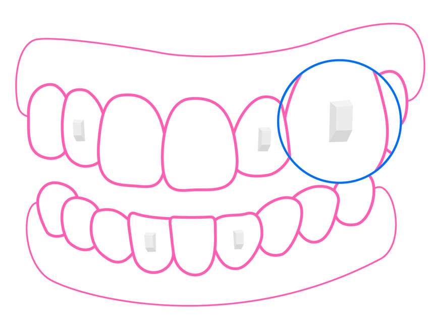 Engagers Attachment Illustration