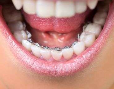 Price_LingualBraces_Desktop